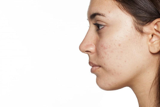 Help! My Teen is Breaking Out: A Safe & Natural Acne Solution Parents Can Trust